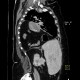Hiatus hernia, gigantic, dyspnea: CT - Computed tomography